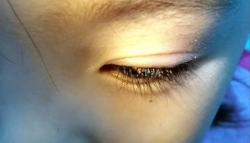宝宝可也要注意卫生哟泪道阻塞:表现为新生儿持续出现的流泪眼屎多