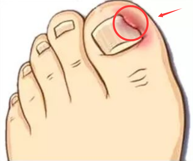 脚指甲总往肉里长?教你一小妙招,轻松解决烦恼
